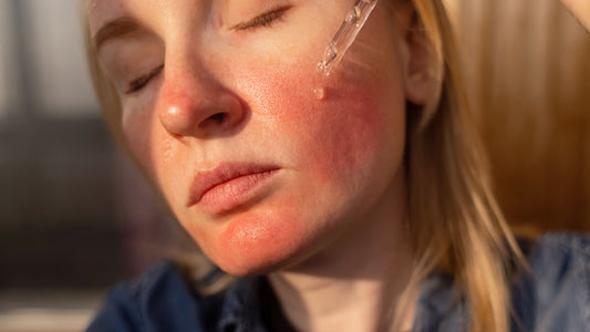 Kvinna applicerar niacinamidserum på röd hud efter microneedling för återfuktning och lugnande hudvård efter behandling.
