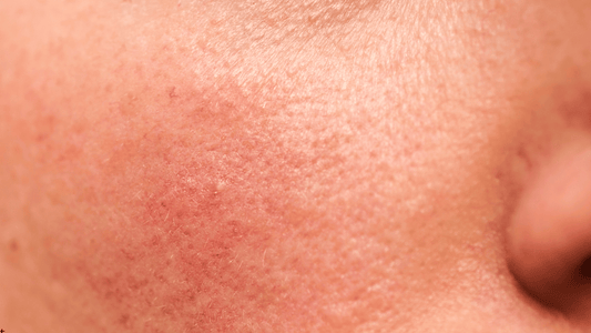 Närbild av hud med synlig rodnad, ytliga blodkärl och ojämn hudton på kinden nära näsan. Bilden illustrerar känslig och irriterad hud som kan förknippas med rosacea eller generell hudrodnad.